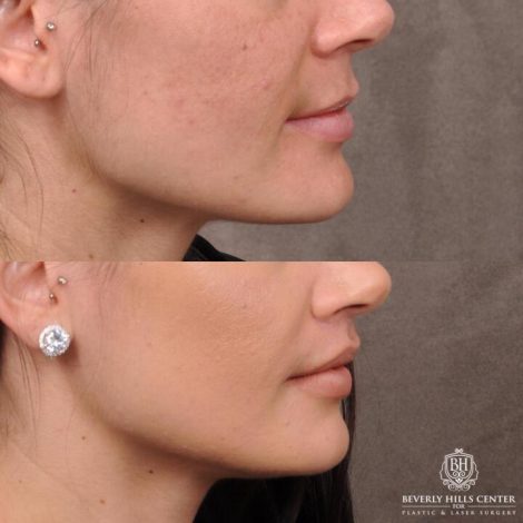 Beverly Hills Center Female Patient Before and After Lip Lift Procedure