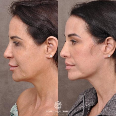 Beverly Hills Center Female Patient Before and After Deep-Plane Face Lift, Upper Lip Lift, Bilateral CUPID LIFT® Corner Lift, Lower Lid Blepharoplasty with Fat Repositioning