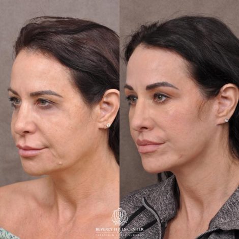 Beverly Hills Center Female Patient Before and After Deep-Plane Face Lift, Upper Lip Lift, Bilateral CUPID LIFT® Corner Lift, Lower Lid Blepharoplasty with Fat Repositioning