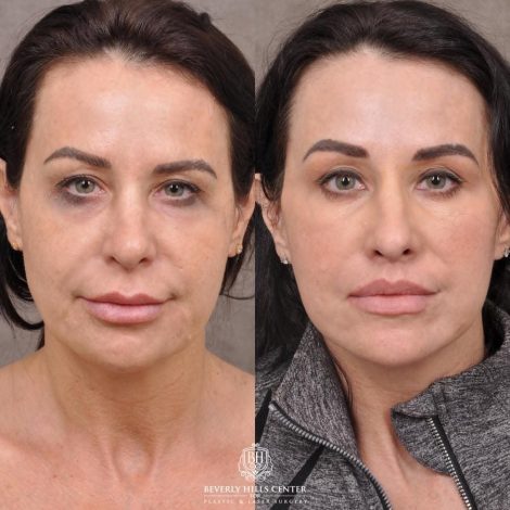 Beverly Hills Center Female Patient Before and After Deep-Plane Face Lift, Upper Lip Lift, Bilateral CUPID LIFT® Corner Lift, Lower Lid Blepharoplasty with Fat Repositioning