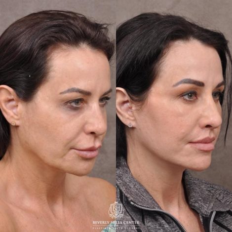 Beverly Hills Center Female Patient Before and After Deep-Plane Face Lift, Upper Lip Lift, Bilateral CUPID LIFT® Corner Lift, Lower Lid Blepharoplasty with Fat Repositioning