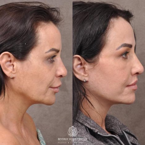 Beverly Hills Center Female Patient Before and After Deep-Plane Face Lift, Upper Lip Lift, Bilateral CUPID LIFT® Corner Lift, Lower Lid Blepharoplasty with Fat Repositioning