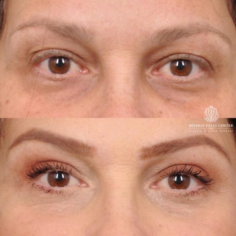 Beverly Hills Center Female Patient Before and After Upper Blepharoplasty, Fat Repositioning, & Lacrimal Gland Pexy