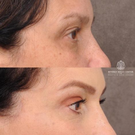 Beverly Hills Center Female Patient Before and After Upper Blepharoplasty, Fat Repositioning, & Lacrimal Gland Pexy