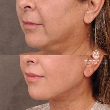 Beverly Hills Center Female Patient Before and After Deep Plane Upper Lip Lift