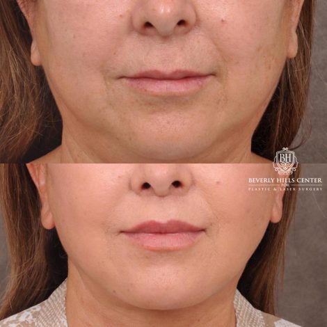 Beverly Hills Center Female Patient Before and After Deep Plane Upper Lip Lift