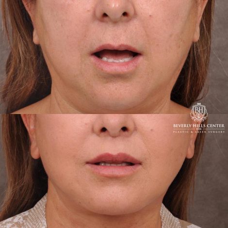 Beverly Hills Center Female Patient Before and After Deep Plane Upper Lip Lift