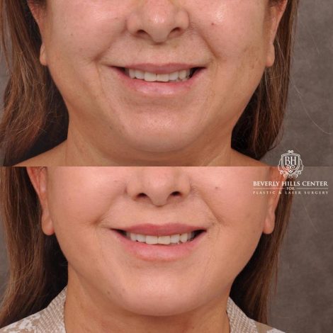 Beverly Hills Center Female Patient Before and After Deep Plane Upper Lip Lift