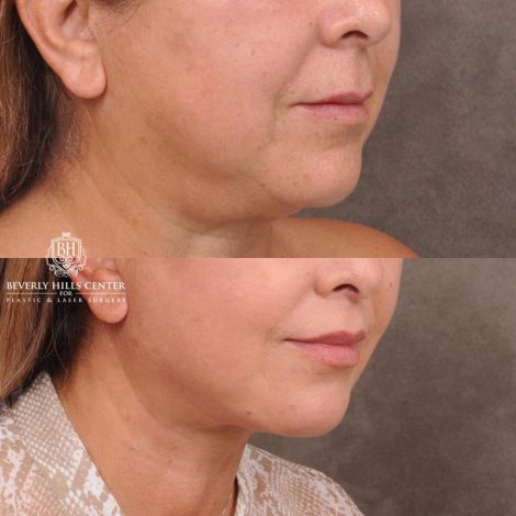 Beverly Hills Center Female Patient Before and After Deep Plane Upper Lip Lift