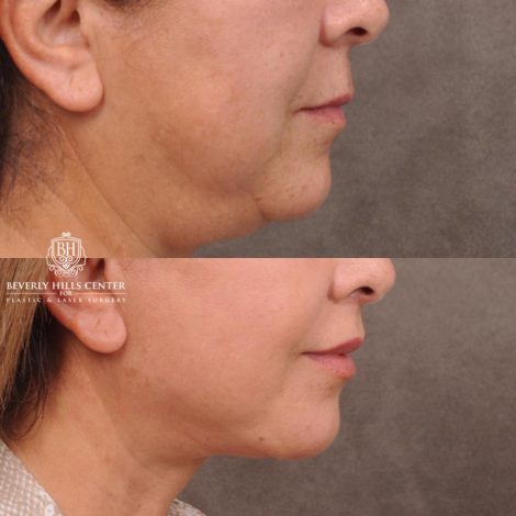 Beverly Hills Center Female Patient Before and After Deep Plane Upper Lip Lift