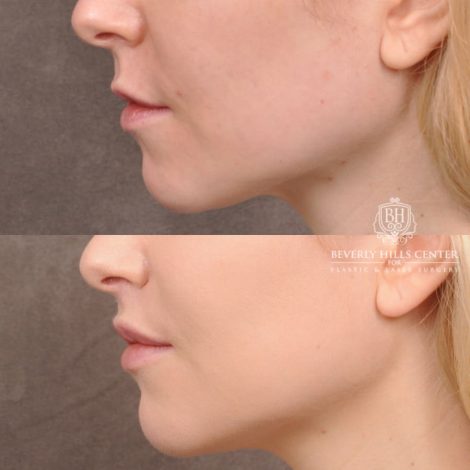 Beverly Hills Center Female Patient Before and After Lip Lift and Corner Lift Procedure