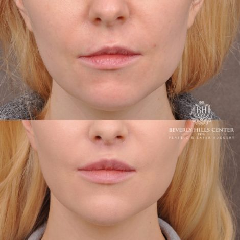 Beverly Hills Center Female Patient Before and After Lip Lift and Corner Lift Procedure