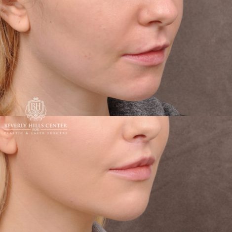 Beverly Hills Center Female Patient Before and After Lip Lift and Corner Lift Procedure