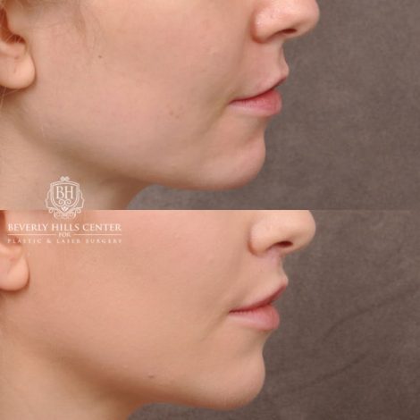 Beverly Hills Center Female Patient Before and After Lip Lift and Corner Lift Procedure