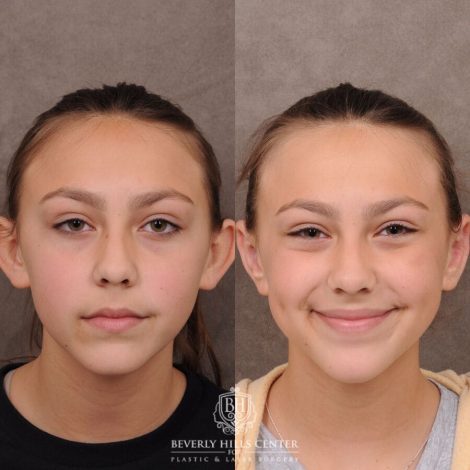 Beverly Hills Center Female Patient Before and After Ear Pinning
