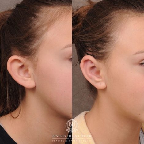 Beverly Hills Center Female Patient Before and After Ear Pinning