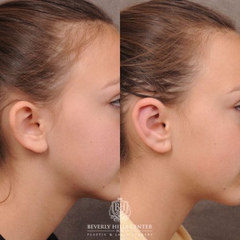 Beverly Hills Center Female Patient Before and After Ear Pinning