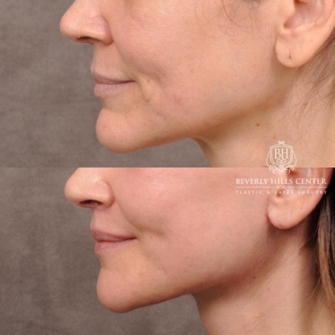 Beverly Hills Center Female Patient Before and After Upper Lift Lift with Corner Release