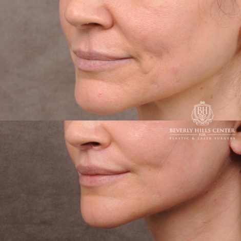 Beverly Hills Center Female Patient Before and After Upper Lift Lift with Corner Release