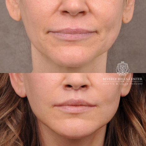Beverly Hills Center Female Patient Before and After Upper Lift Lift with Corner Release