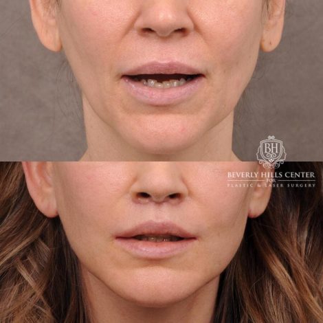 Beverly Hills Center Female Patient Before and After Upper Lift Lift with Corner Release