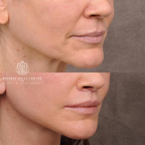 Beverly Hills Center Female Patient Before and After Upper Lift Lift with Corner Release