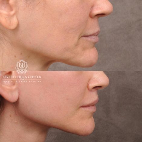 Beverly Hills Center Female Patient Before and After Upper Lift Lift with Corner Release