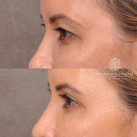 Beverly Hills Center Female Patient Before and After Blepharoplasty