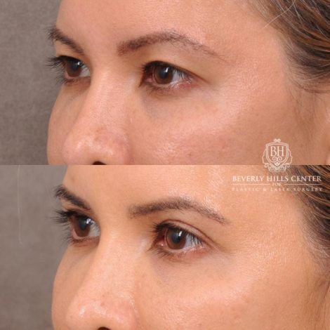 Beverly Hills Center Female Patient Before and After Blepharoplasty