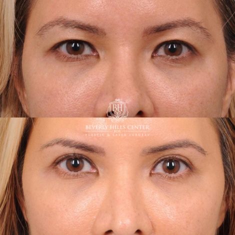 Beverly Hills Center Female Patient Before and After Blepharoplasty