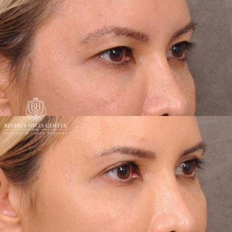 Beverly Hills Center Female Patient Before and After Blepharoplasty
