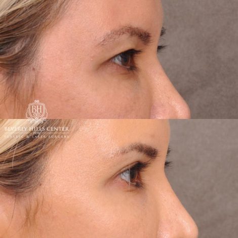 Beverly Hills Center Female Patient Before and After Blepharoplasty