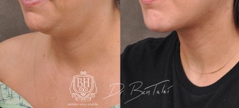 Beverly Hills Center Female Patient Before and After Profound Rf