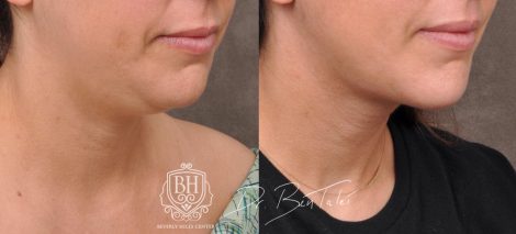 Beverly Hills Center Female Patient Before and After Profound Rf