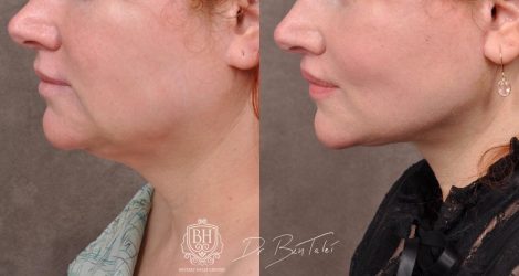Beverly Hills Center Female Patient Before and After AuraLyft and Revision Deep Plane Lip Lift