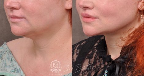 Beverly Hills Center Female Patient Before and After AuraLyft and Revision Deep Plane Lip Lift