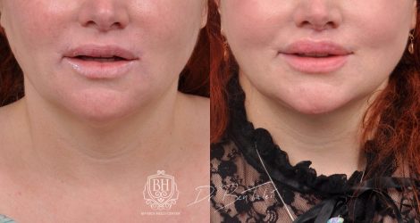Beverly Hills Center Female Patient Before and After AuraLyft and Revision Deep Plane Lip Lift