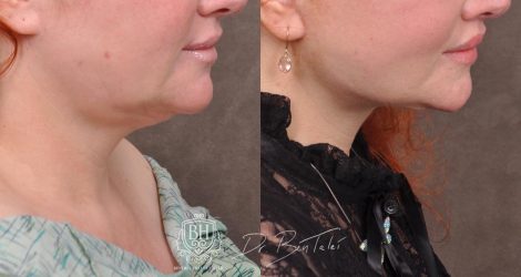 Beverly Hills Center Female Patient Before and After AuraLyft and Revision Deep Plane Lip Lift