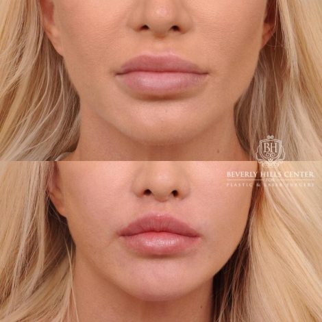Beverly Hills Center Female Patient Before and After Dissolved Filler, Deep Plane Lip Lift, CUPID LIFT® Corner Lift