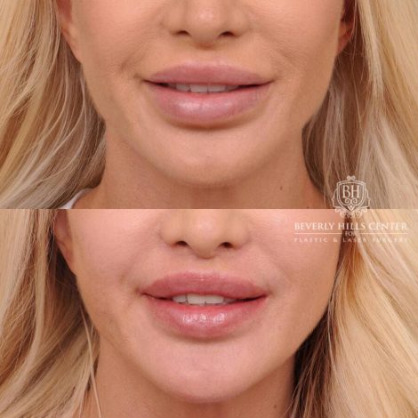 Beverly Hills Center Female Patient Before and After Dissolved Filler, Deep Plane Lip Lift, CUPID LIFT® Corner Lift