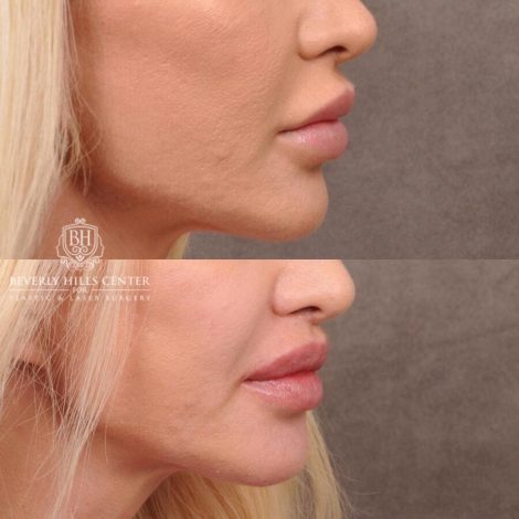 Beverly Hills Center Female Patient Before and After Dissolved Filler, Deep Plane Lip Lift, CUPID LIFT® Corner Lift