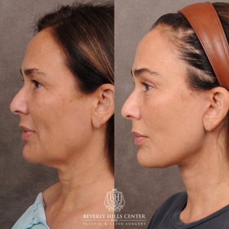 Beverly Hills Center Female Patient Before and After AuraLyft, Brow Lift Procedure