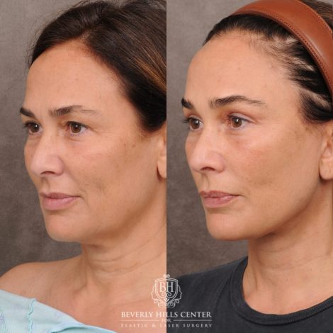 Beverly Hills Center Female Patient Before and After AuraLyft, Brow Lift Procedure