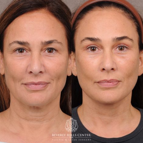 Beverly Hills Center Female Patient Before and After AuraLyft, Brow Lift Procedure