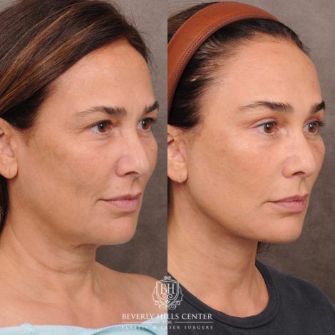 Beverly Hills Center Female Patient Before and After AuraLyft, Brow Lift Procedure