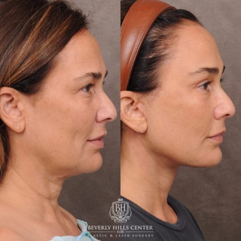 Beverly Hills Center Female Patient Before and After AuraLyft, Brow Lift Procedure