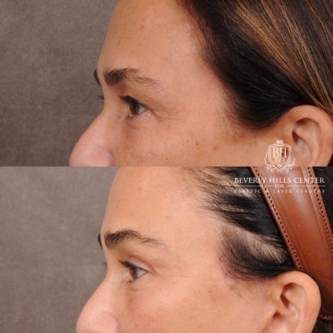 Beverly Hills Center Female Patient Before and After AuraLyft, Brow Lift Procedure