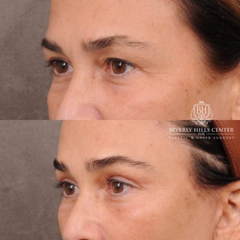 Beverly Hills Center Female Patient Before and After AuraLyft, Brow Lift Procedure