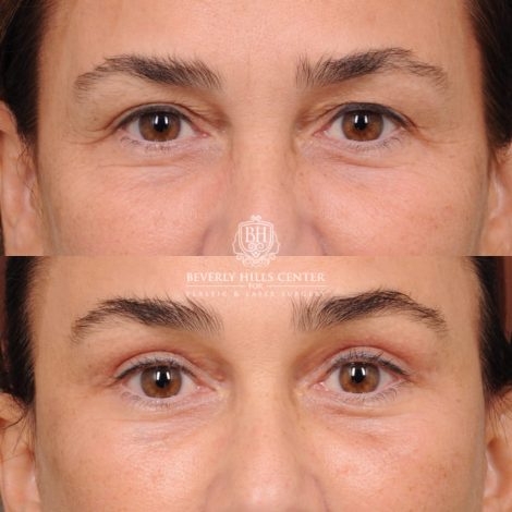 Beverly Hills Center Female Patient Before and After AuraLyft, Brow Lift Procedure