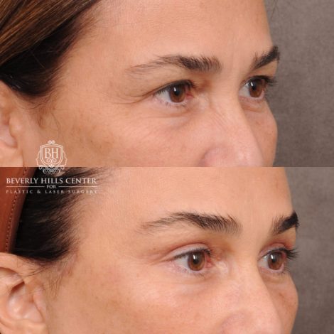 Beverly Hills Center Female Patient Before and After AuraLyft, Brow Lift Procedure